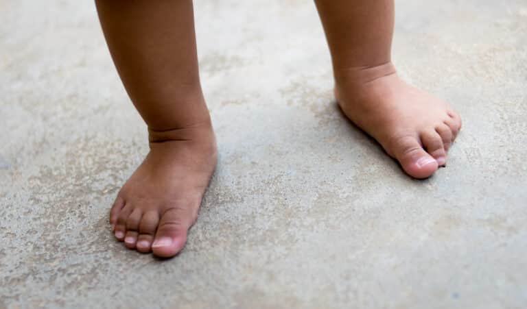 flat feet advice by kids physio